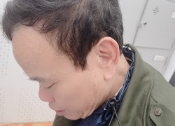 Bán máy trợ thính cho người nghe kém mức độ trung bình tại Thanh Hóa.