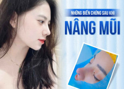 Những biến chứng có thể xảy ra sau khi nâng mũi