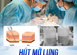 Hút Mỡ Lưng Và Cách Duy Trì Kết Quả