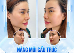 Dáng mũi phổ biến