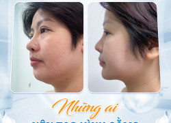 Phẫu thuật tạo hình cằm