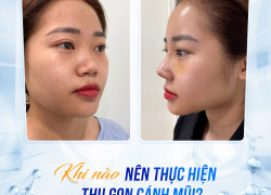 Lợi ích khi thu gọn cánh mũi