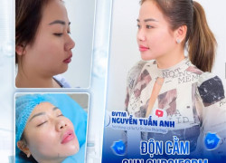 Độn cằm sụn surgiform
