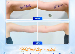Hút Mỡ Tay Nách – Giải Pháp Cho Vùng Cánh Thon Gọn