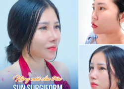 Nâng mũi cấu trúc sụn surgiform