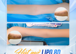 Giải Pháp Cho Bắp Tay Thon Gọn Không Cần Tập Luyện