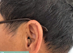 MÁY TRỢ THÍNH NHỎ GỌN, KÍN ĐÁO TRONG TAI