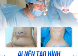 Phẫu thuật tạo hình thành bụng và những điều cần biết