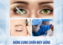 Nâng cung chân ma.y bằng botox