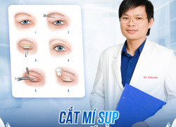 Cắt mí có thay đổi vận mệnh không