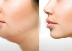 Giải đáp thắc mắc về tiêm Filler