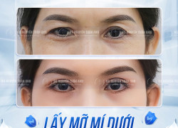 Hiểu rõ nguyên nhân hình thành quầng thâm dưới mắt