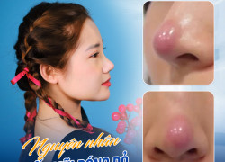 Mũi bị bóng đỏ có ảnh hưởng gì không ?