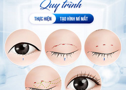 Lợi ích nổi bật của cắt mí mini deep