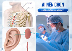 Vì sao nâng mũi bằng sụn sườn ngày càng được ưa chuộng?