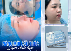 Xu hướng tạo dáng mũi tự nhiên trong làm đẹp hiện đại
