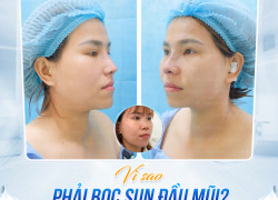 Bọc sụn đầu mũi có giúp phòng ngừa lộ sóng hiệu quả không?