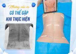 Hút mỡ siết eo khi nào nên thực hiện cùng lúc để đạt hiệu quả cao?