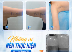 Hút mỡ nách có giúp cải thiện rõ rệt vóc dáng và loại bỏ mỡ dư thừa hiệu quả?
