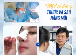 Sau khi nâng mũi bị sưng bầm là do bác sĩ?