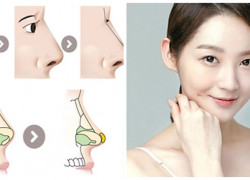 Ưu điểm của nâng mũi bọc Megaderm trong thẩm mỹ mũi