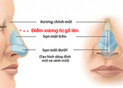 Sửa mũi lệch nhẹ không cần phẫu thuật lớn có khả thi không?