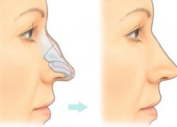 Giải pháp chỉnh mũi lệch nhẹ không cần “đụng dao kéo”