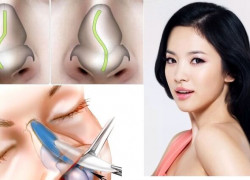 Có nên phẫu thuật lại khi mũi bị lộ sóng nhẹ