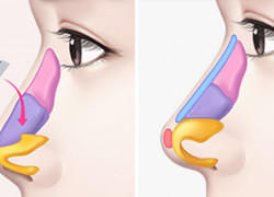 Lộ sóng mũi nhẹ xử lý thế nào cho hiệu quả