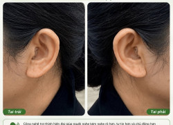 Nghe kém lâu năm, điều gì đã thay đổi bác Hoa sau 1 tháng đeo máy trợ thính ?